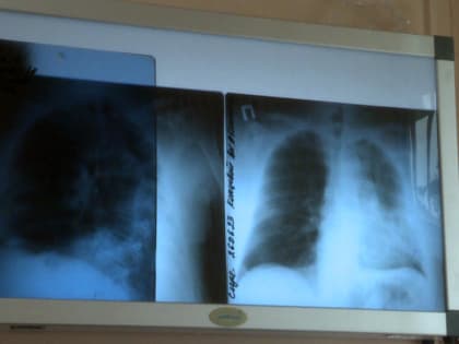 Неделя профилактики рака легких проходит в Калужской области