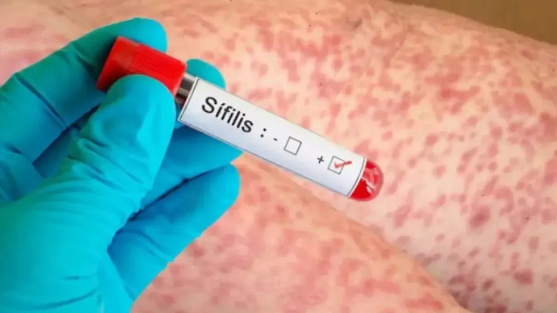 Los casos de sífilis en Tucumán se dispararon el 52% y lideran el incremento en el NOA