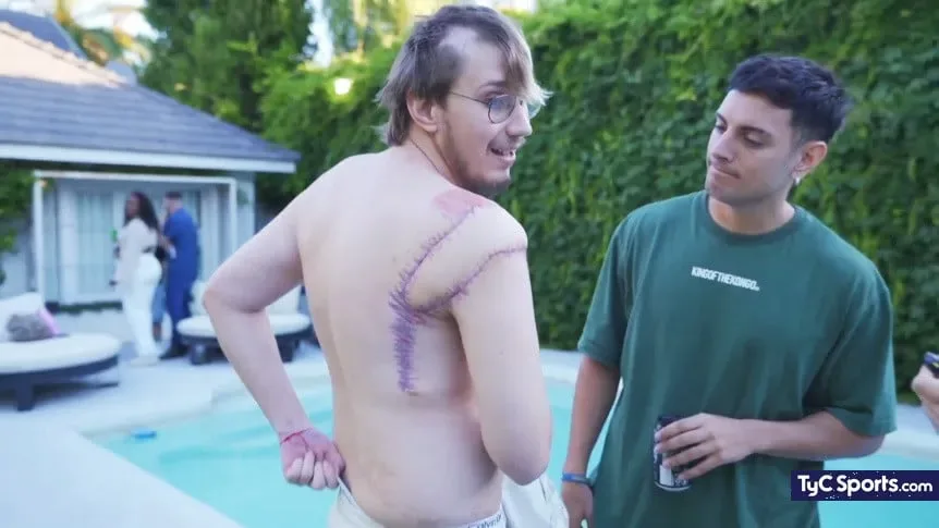 “Me reconstruyeron”: Brunenger exhibió sus cicatrices tras el grave choque