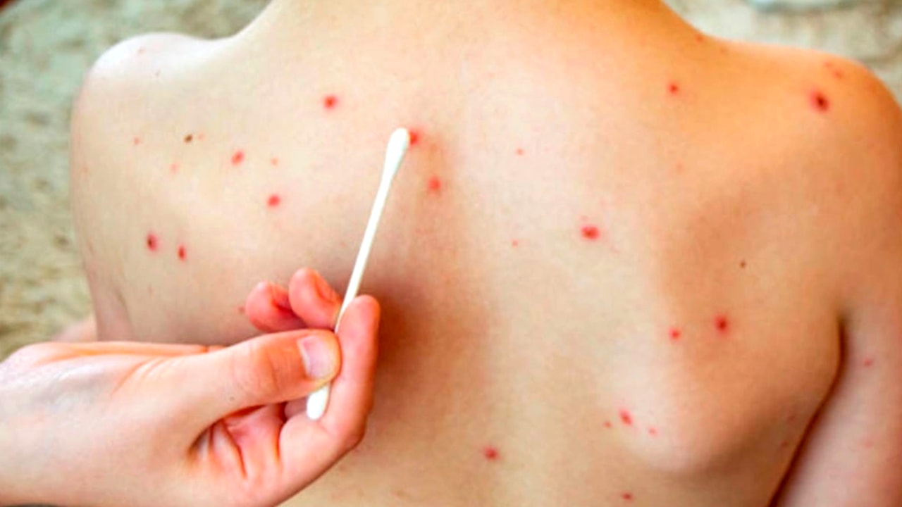 Se confirmó un caso de sarampión y hay alerta epidemiológica