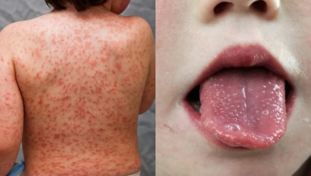 Día Mundial de la Enfermedad de Kawasaki: una patología poco frecuente que afecta a niños pequeños