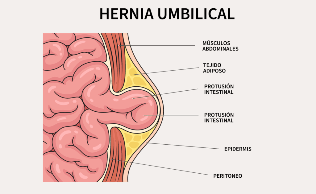 HERNIA-UMBILICAL-ILUSTRACION-1024x629.png