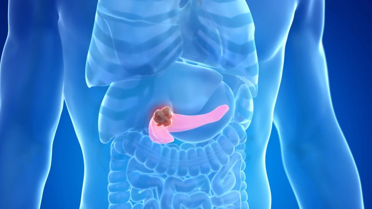 Presentaron avances disruptivos en el tratamiento del cáncer de páncreas en ASCO