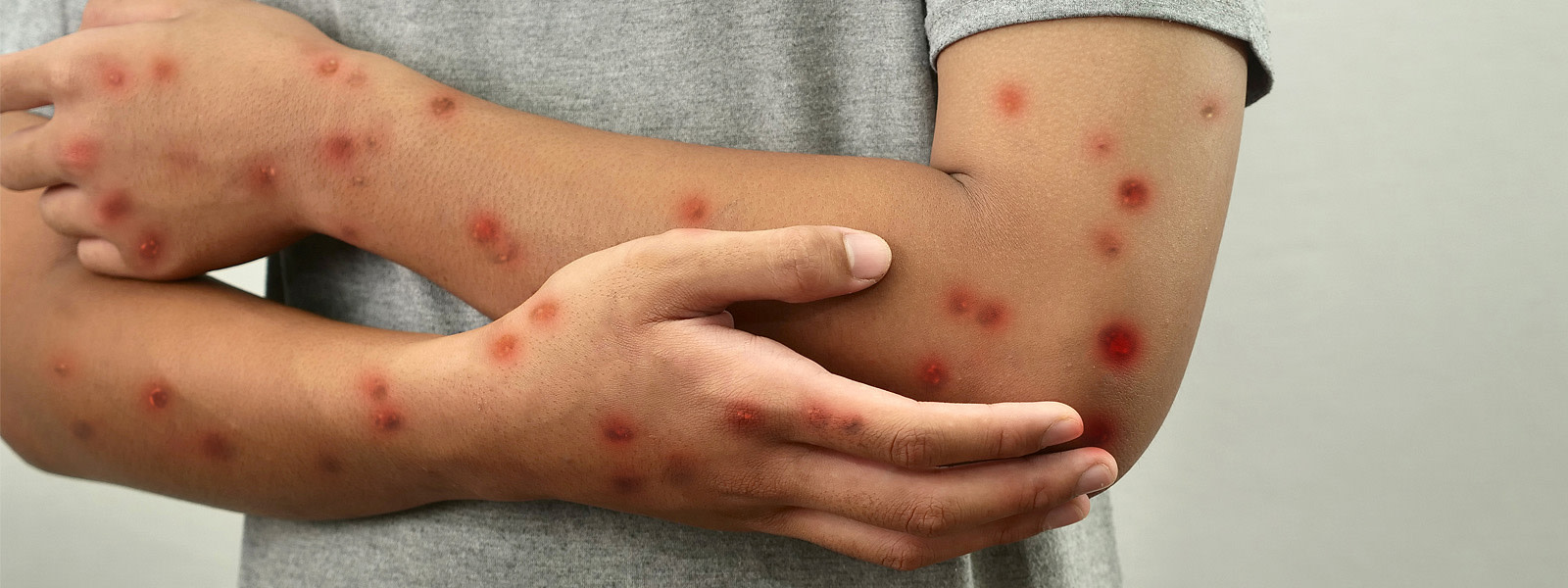 Mpox en Argentina: detectan tres nuevos casos y ya suman 11 en 2026