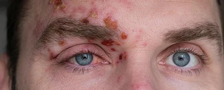 Un herpes en el ojo puede costar la vista: la advertencia de un especialista