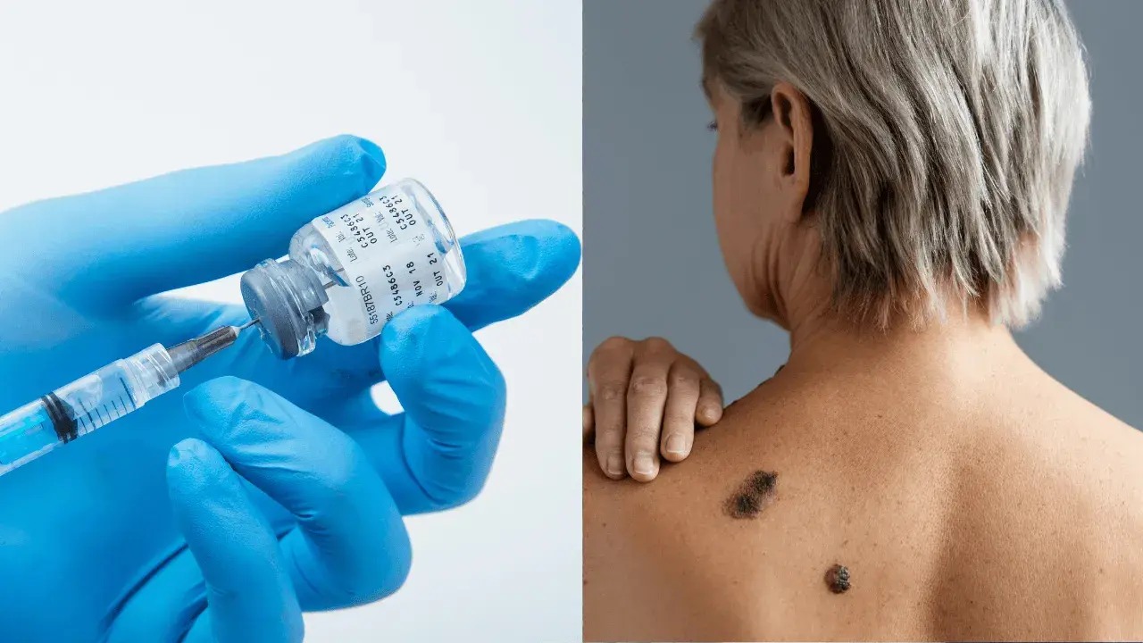 Vacuna contra el melanoma: por qué un oncólogo pide cautela con los resultados que se difundieron