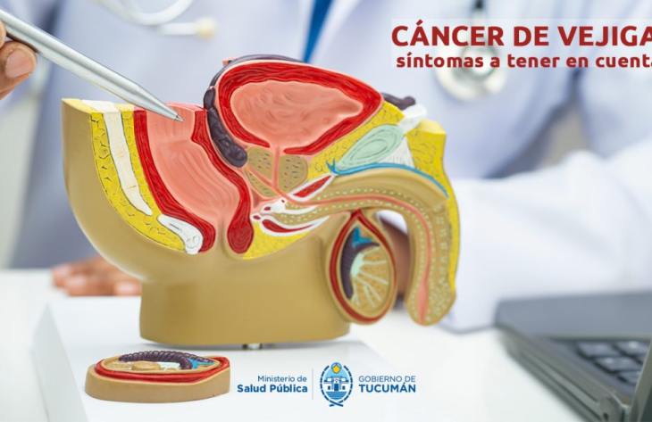 Especialistas advierten sobre los signos de alerta para la detección temprana del cáncer de vejiga