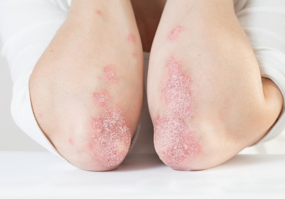Abordaje dermatológico: especialistas piden considerar la ubicación de la psoriasis al definir los tratamientos