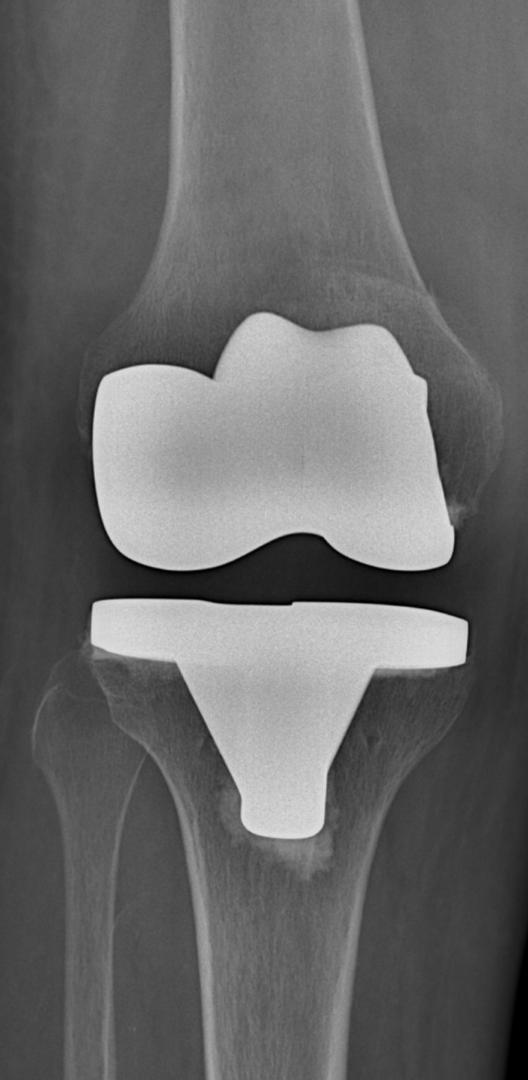 Joint Replacement