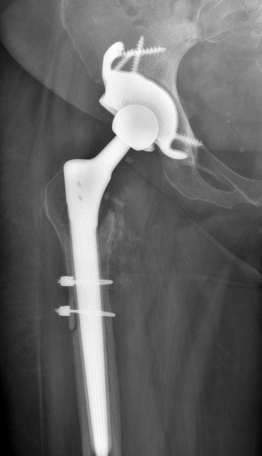 Revision Joint Replacement