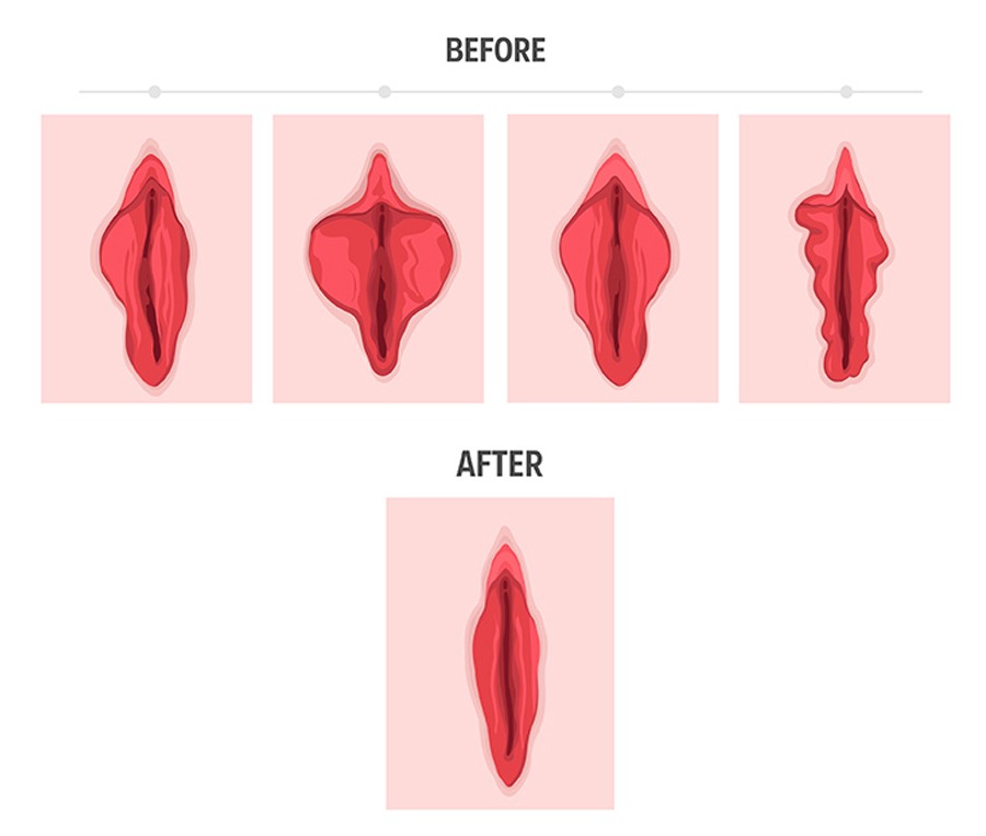 Labiaplasty: What to Know Before Your Consultation
