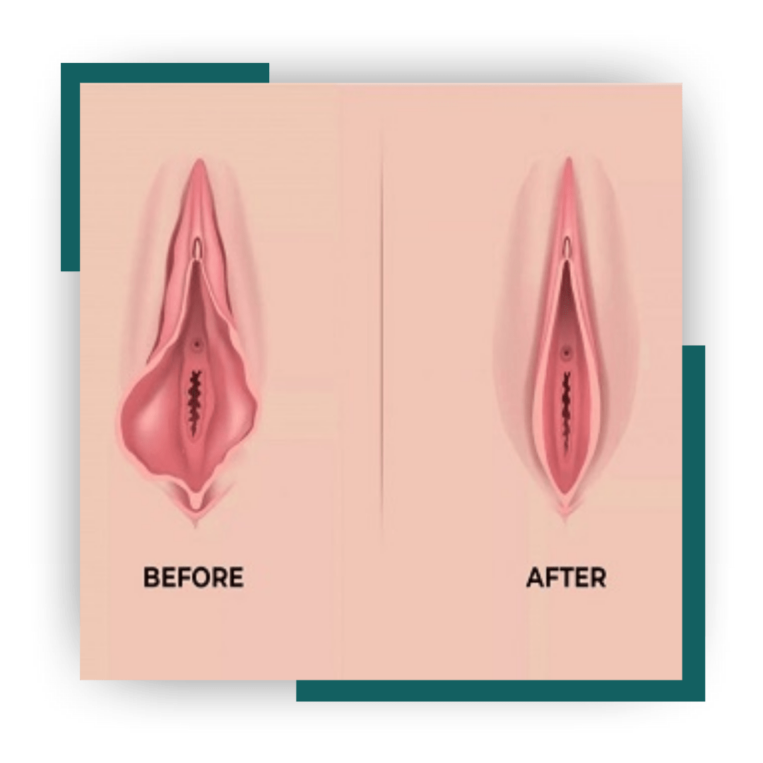 Labiaplasty Dublin: Personalised Surgery for Every Body | Gerka Clinic