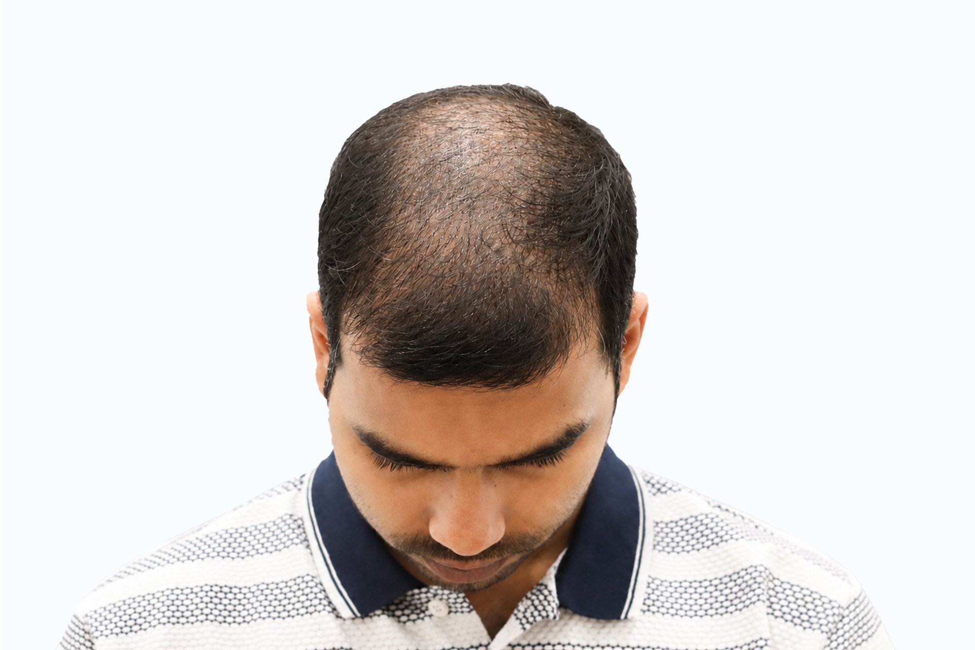 Pankaj Kumar before photo - front