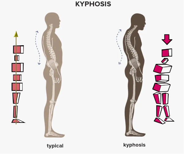 Illustrazione della postura corretta e della cifosi