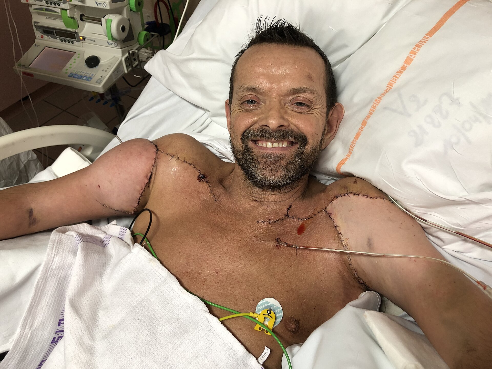 Félix Grétarsson cinco dias depois do transplante realizado na França. Foto: Felixfranski/Wikimedia Commons – CC BY-SA 4.0.