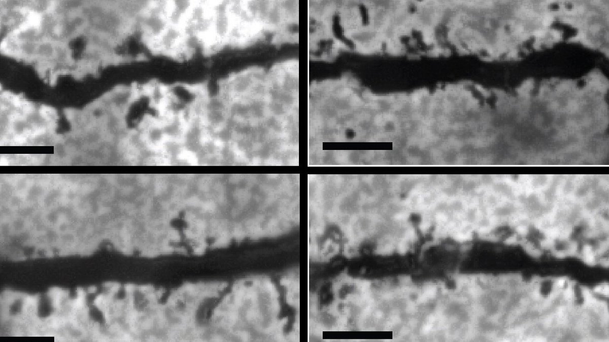 Schizophrenia treatment shows new promise for patients