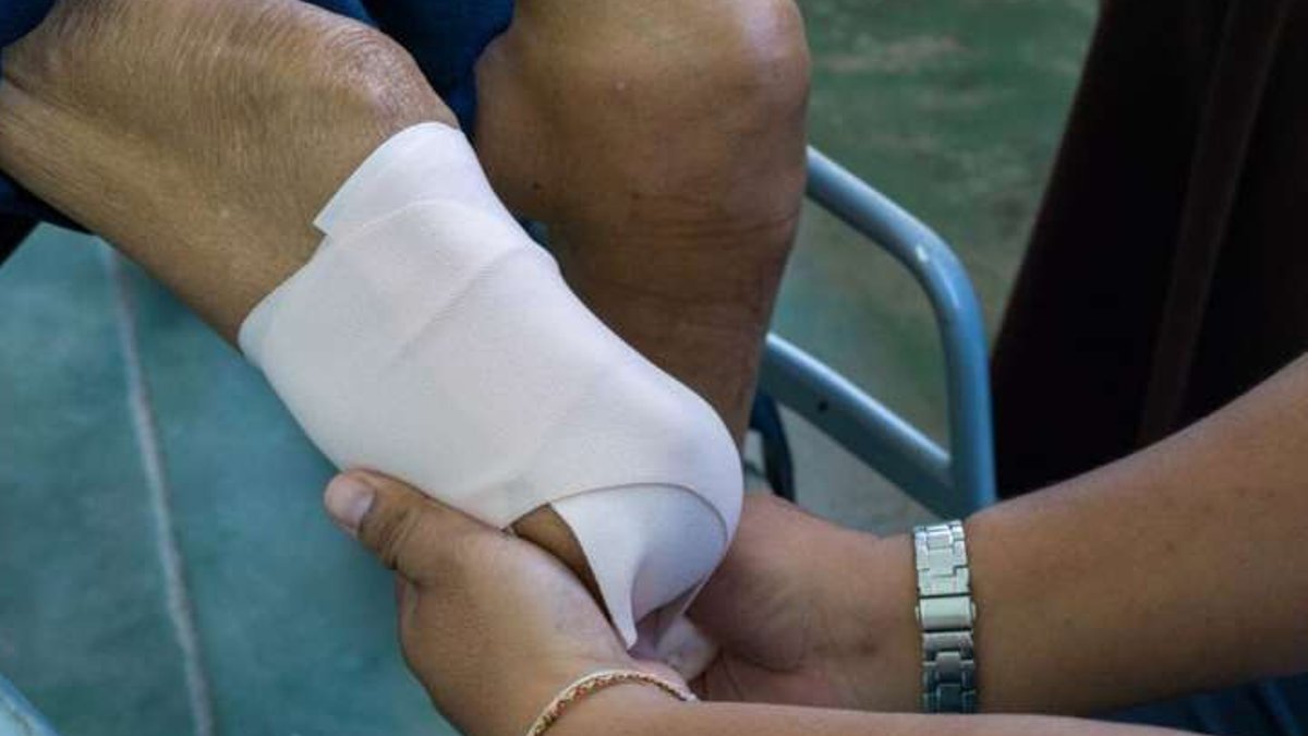 Amputation rates rise in US hospitals