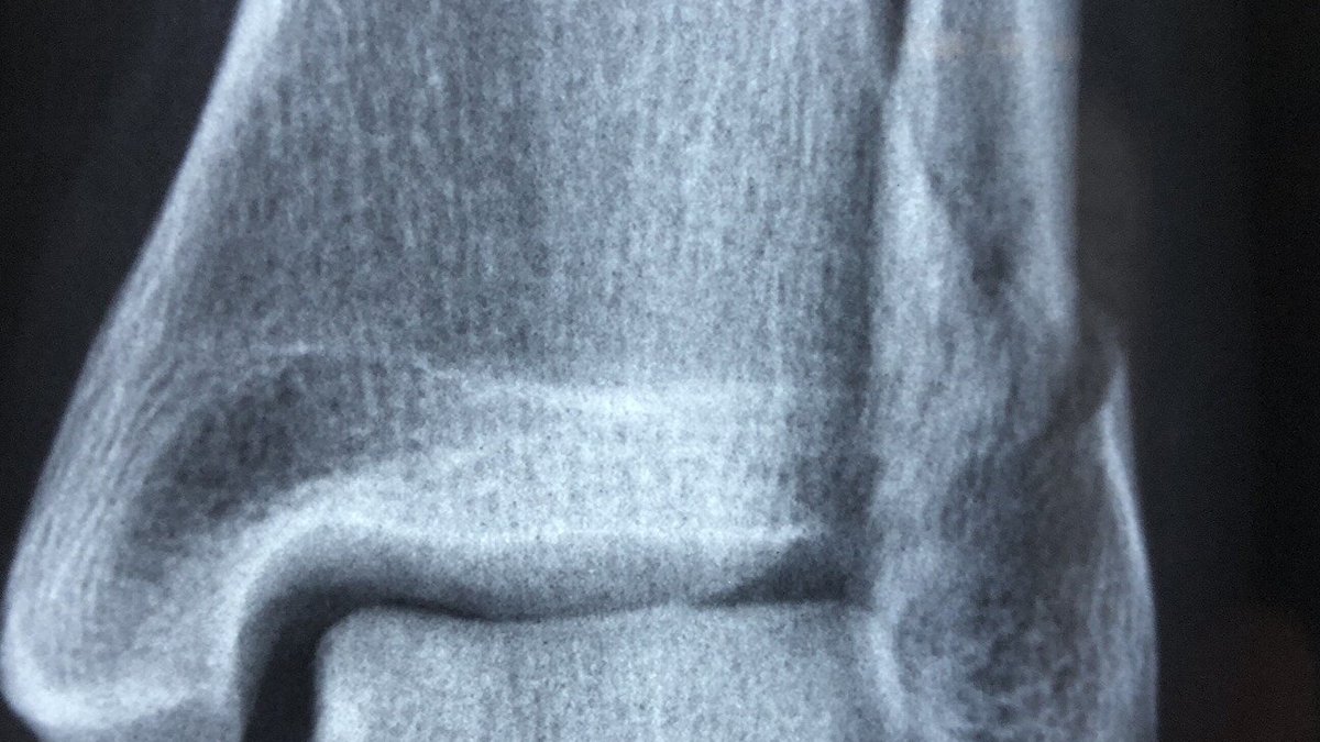 New treatment approach needed for brittle bones