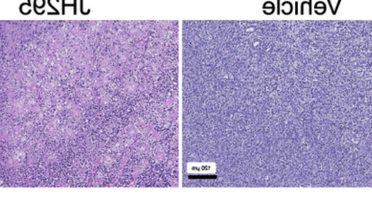 New Therapy Shows Promise for Lymphoma Patients