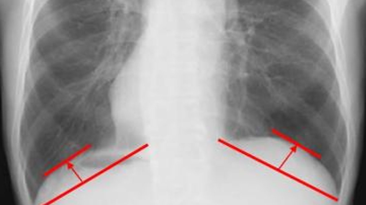 Simple X-ray tied to survival in lung cancer surgery patients Simple X-ray tied to survival in lung cancer surgery patients - x-ray survival