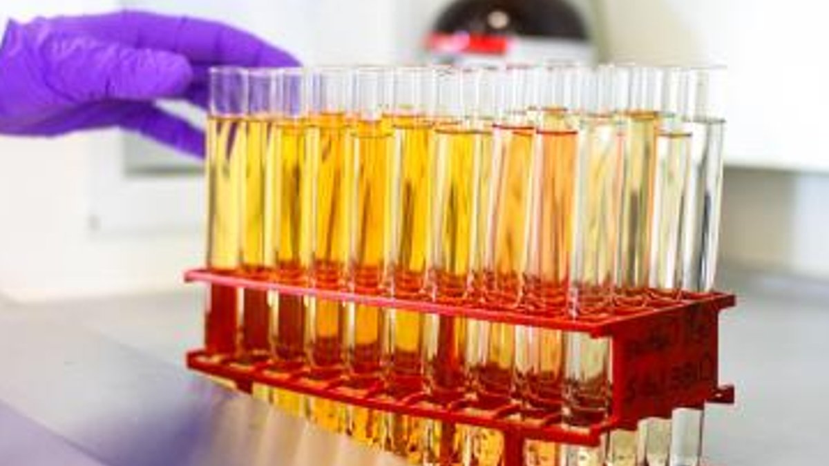 Urine test may spot lung cancer years early Urine test may spot lung cancer years early - lung cancer test