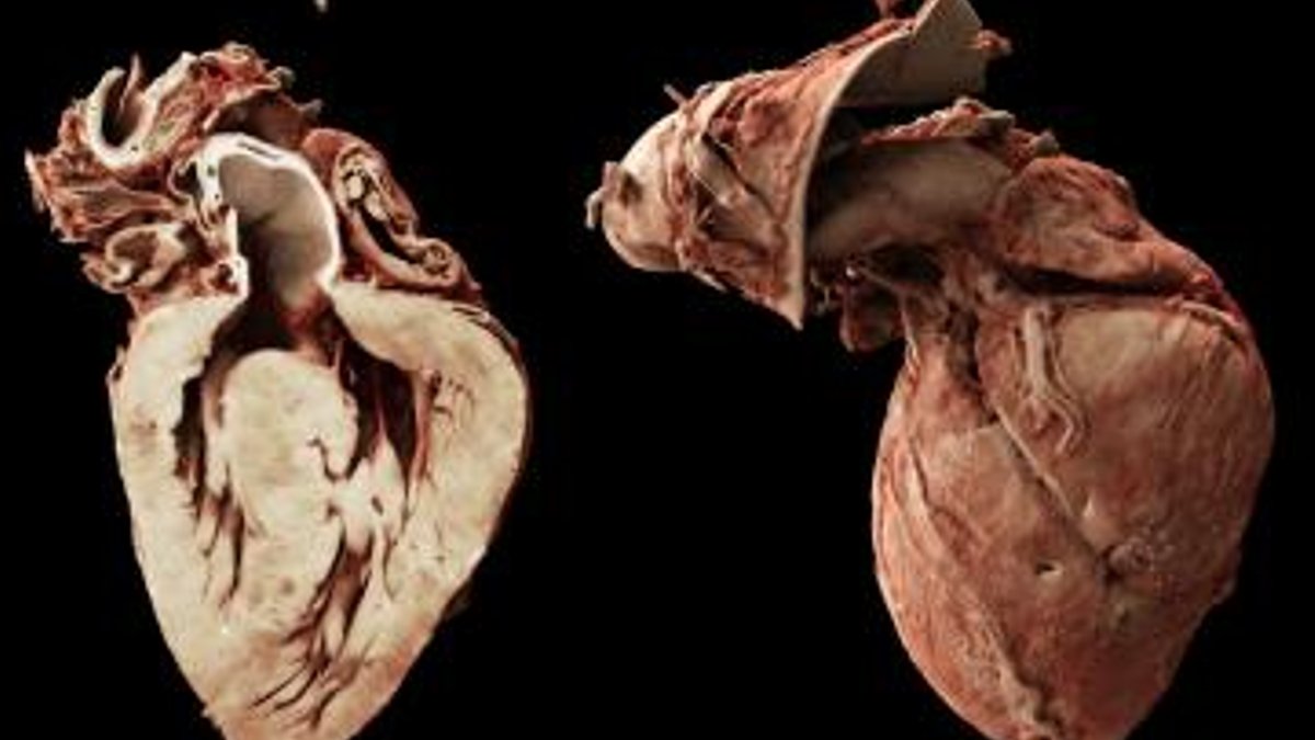3D map reveals new insights into Tetralogy of Fallot 3D map reveals new insights into Tetralogy of Fallot - tetralogy fallot