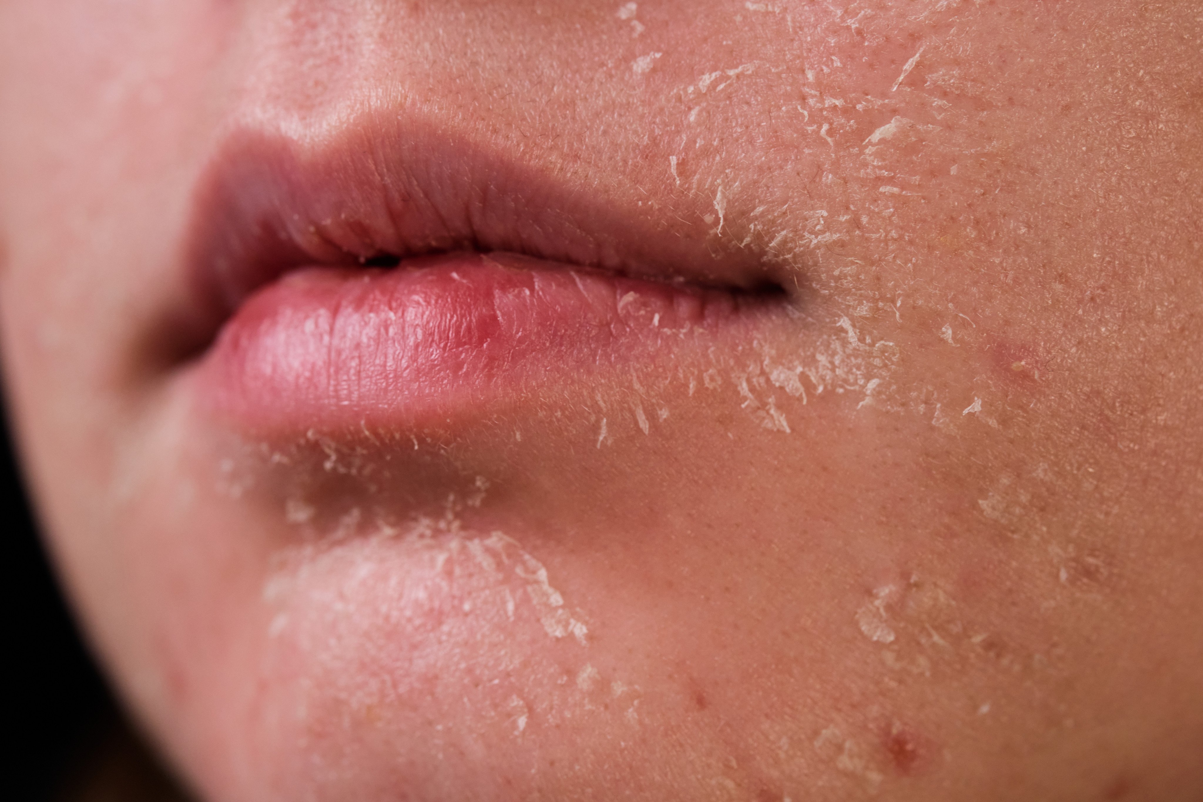 Why Your Skin Is So Dry In Winter? Let’s Treat It!