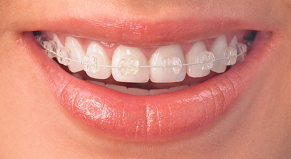 Add a Pop of Color to Your Smile with Trendy Braces Options in Dubai