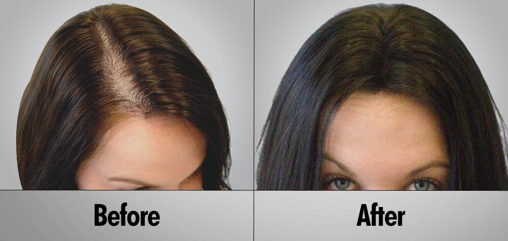 Hair transplants for women: what you need to know