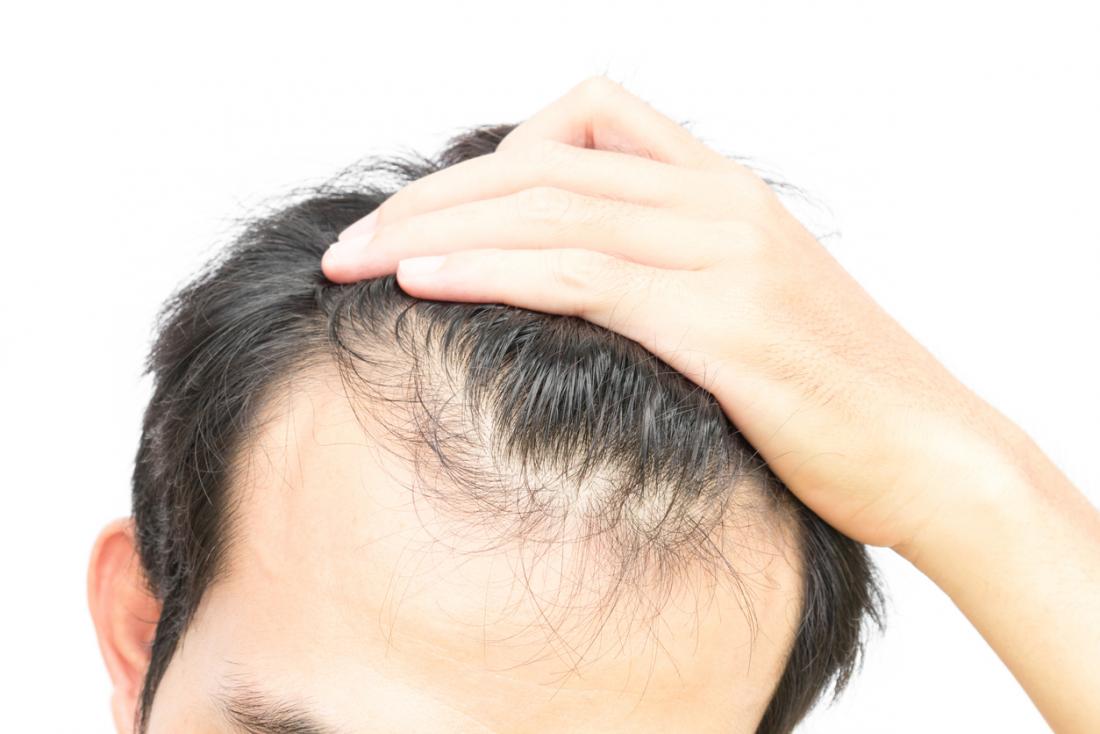 Does Onion Help in Hair Growth