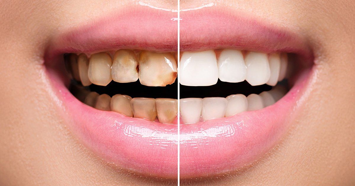 What Exactly Are Veneers, and Why Should You Choose Them?