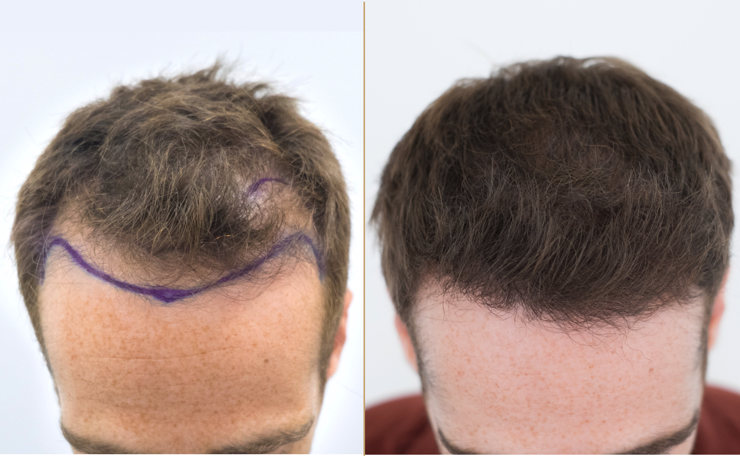 Maximizing the results of a hair transplant
