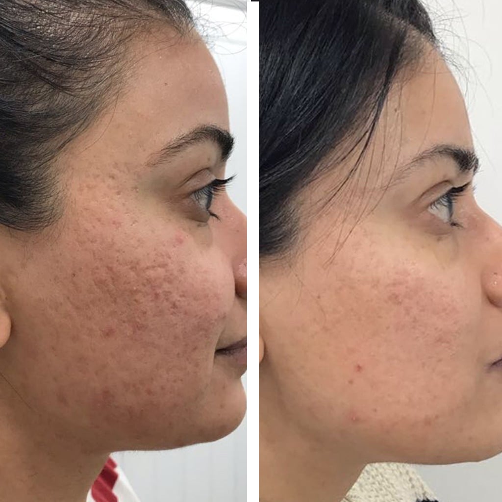 6 Factors to Consider Before Microneedling