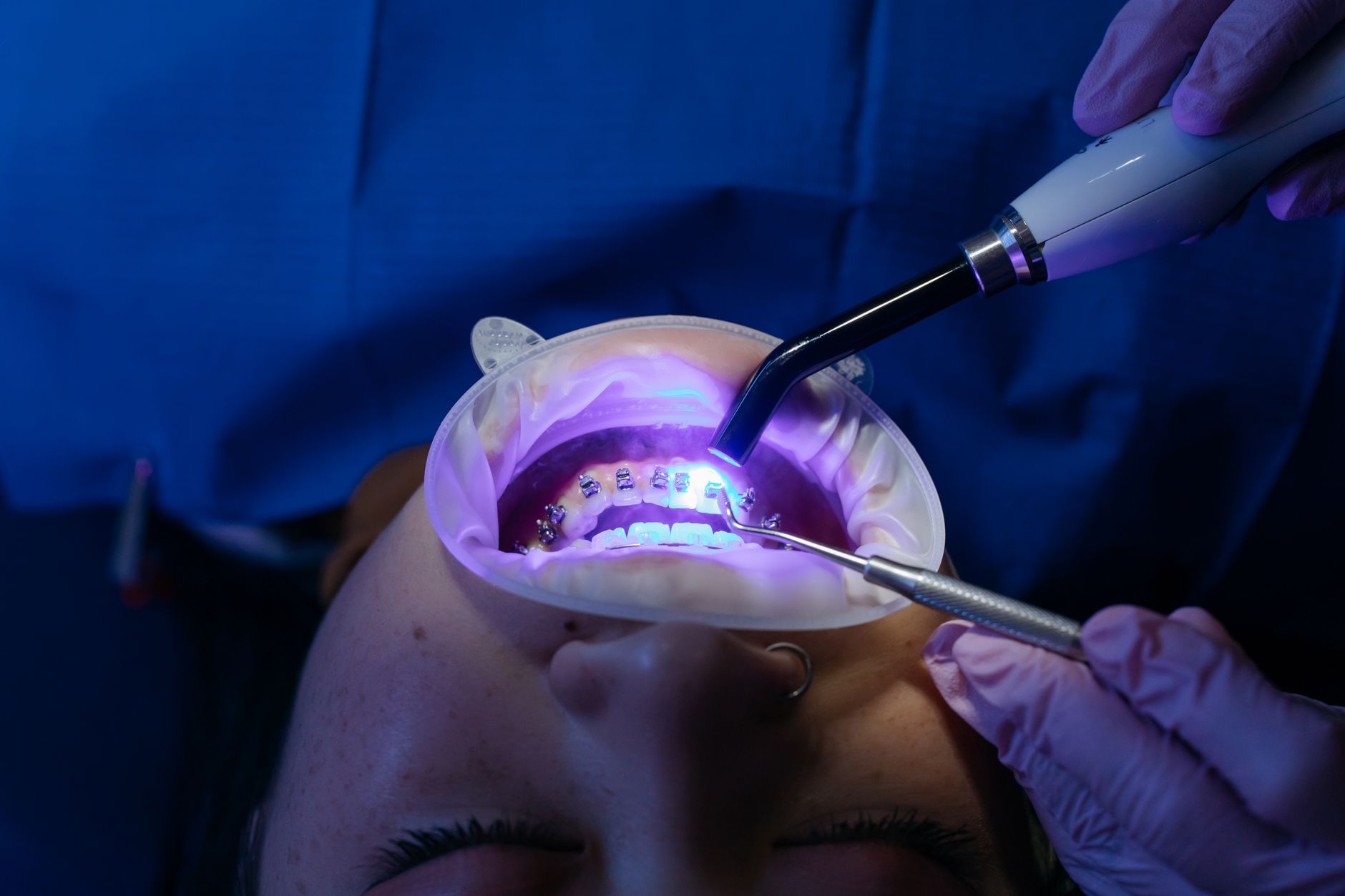 The Adult Orthodontics Facts that Most People Have Been Missing Over the Years
