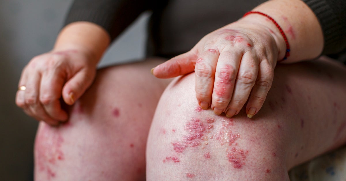 Common Treatments People with Psoriasis Can Seek