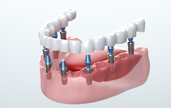 Understanding The Complex Nature of Dental Implants