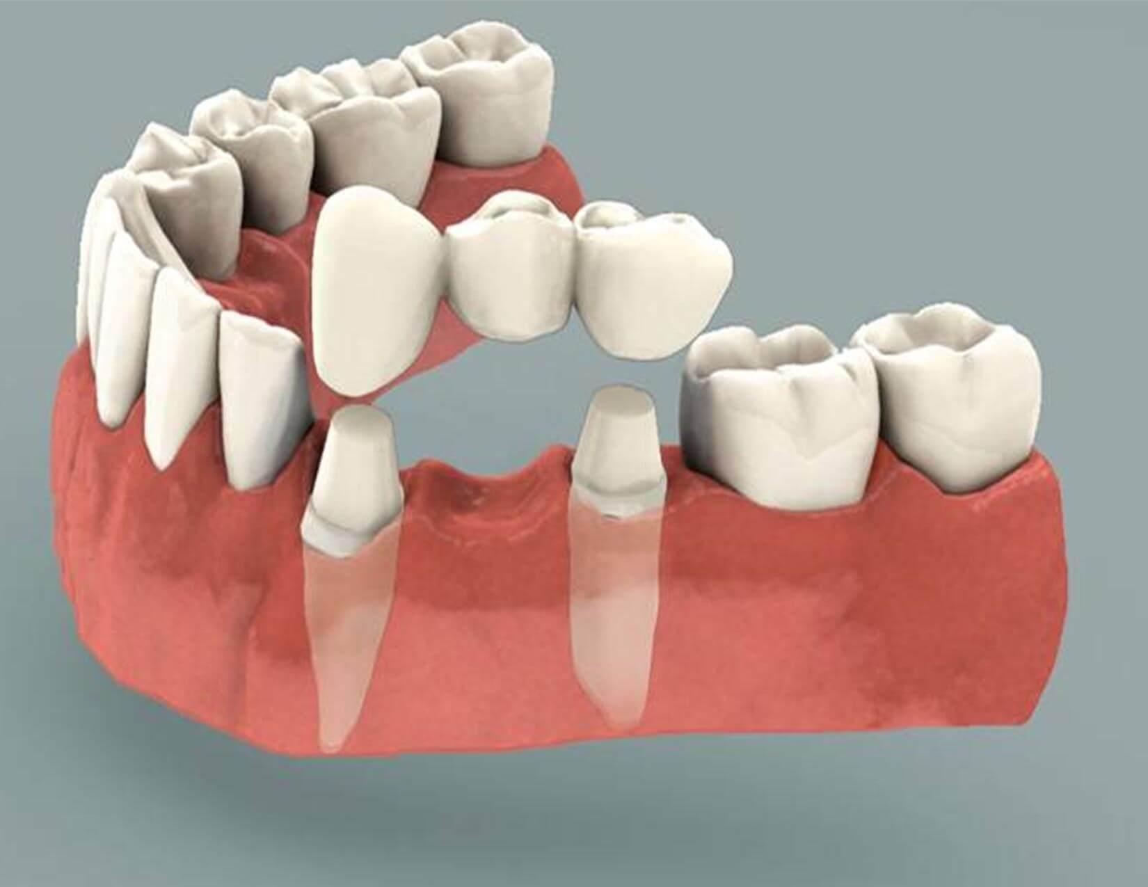 Common Issues with Dental Bridges & How to Solve Them in Lincoln, NE