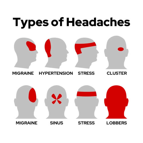 Types of Headaches (Lobbers)