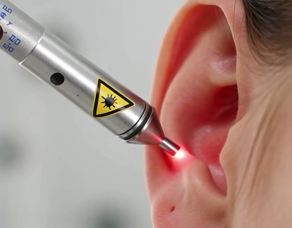 Close-up du laser VIRAA® en utilisation