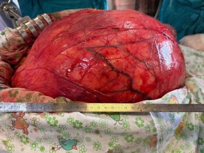 Спасение жизни: хирурги Краснодарского края удалили гигантскую опухоль