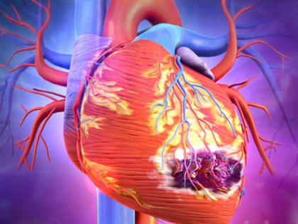 Инфаркт миокарда: причины, первая помощь, профилактика