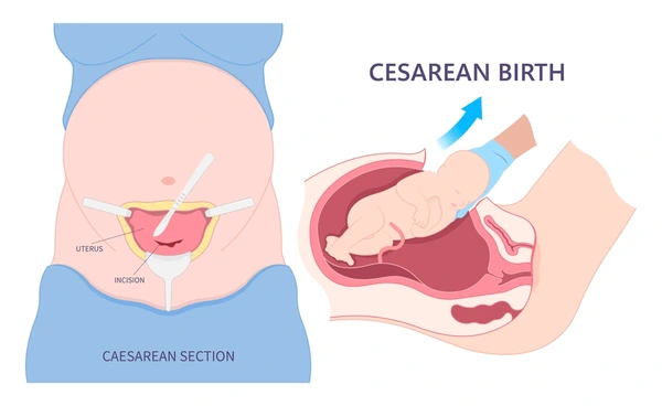 Cesarean birth surgical procedure illustration