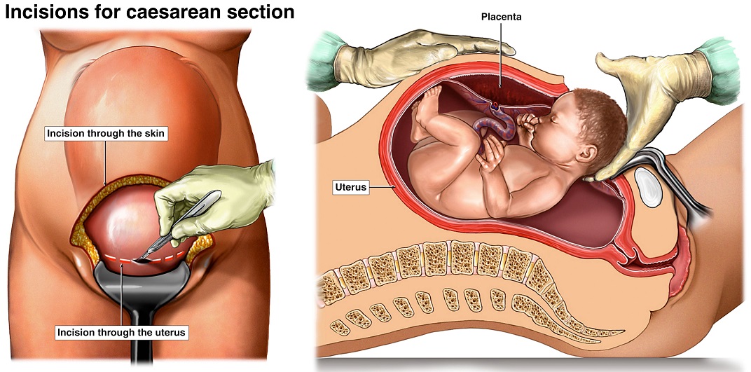 Diagram showing caesarean section action and effect