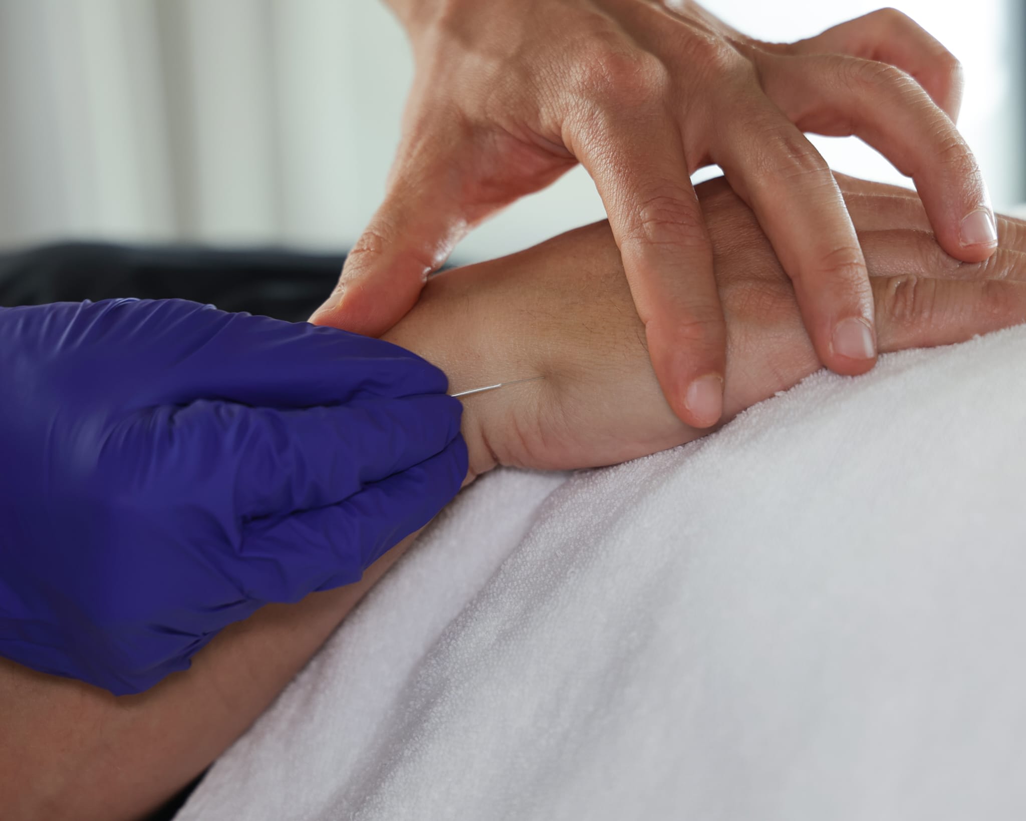 Acupuntura en Mano 