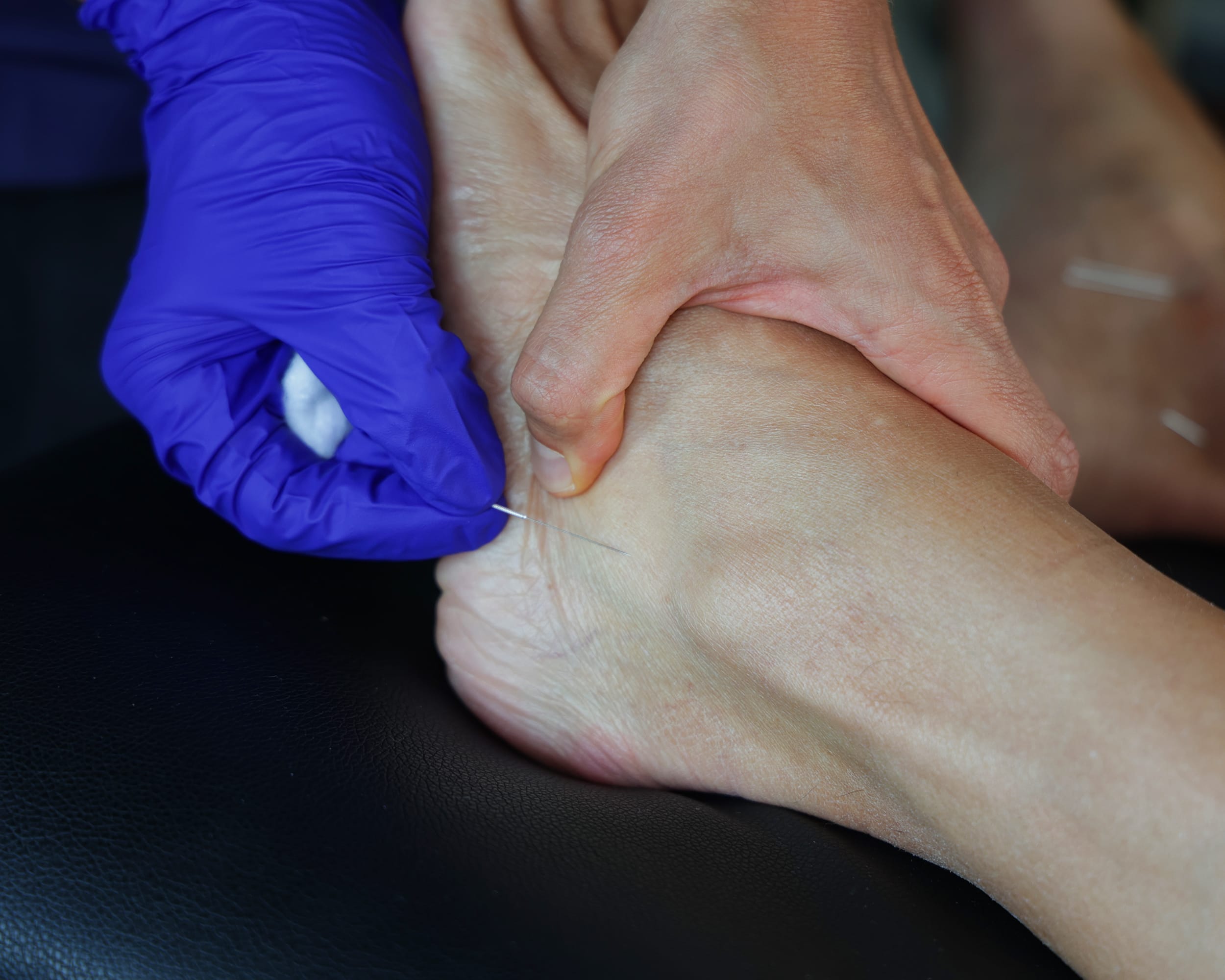 Acupuntura en pie