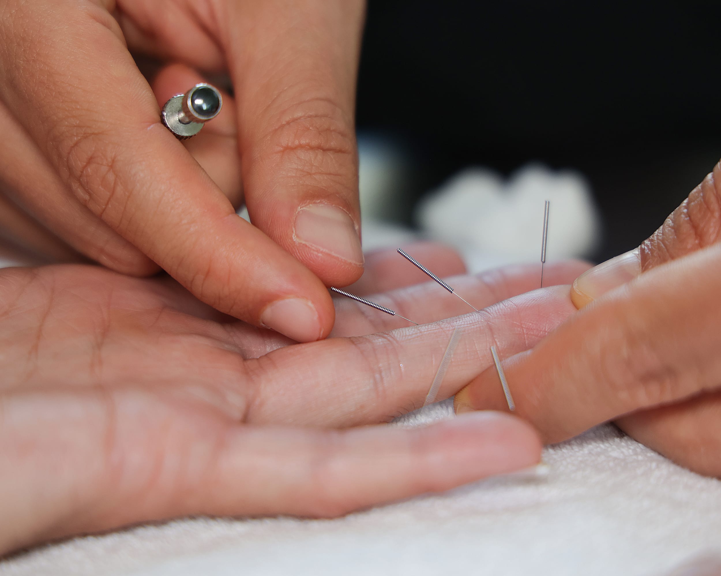 Acupuntura en Dedos