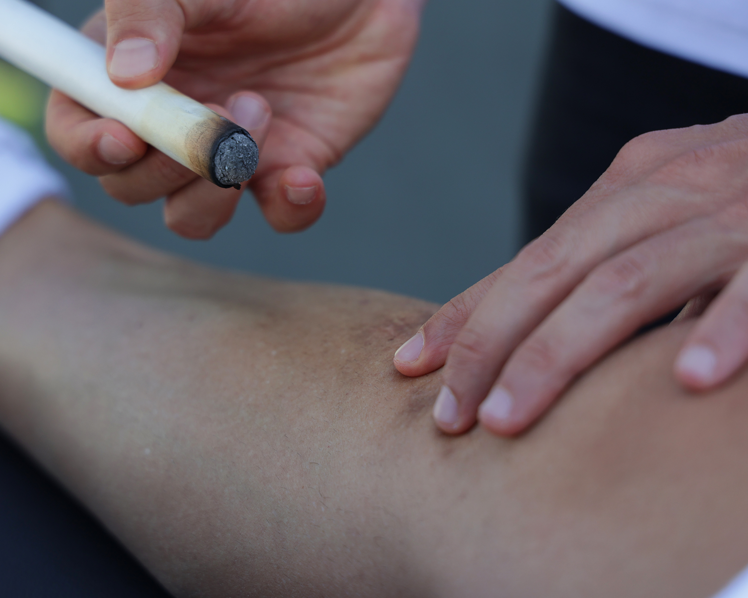 Acupuntura moxibustión