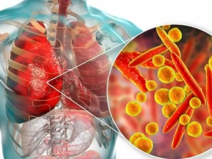 Рост заболеваемости микоплазменной пневмонией в России
