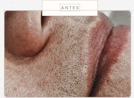 Resultado antes e depois - Epilação a laser