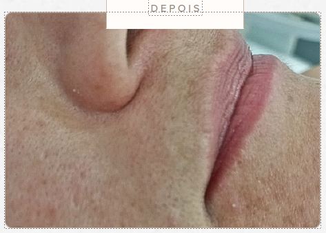 Resultado antes e depois - Epilação a laser